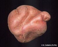 déformation Physiologique déformation Physiologique