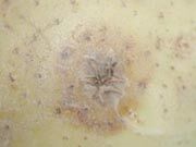 Corky lesions with halo Corky lesions with halo